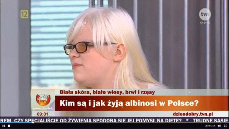 Coraz głośniej o albinosce